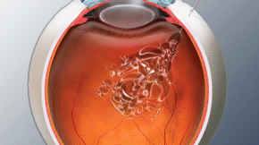 جراحات الشبكية والجسم الزجاجي