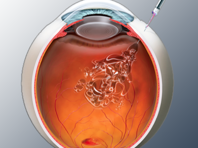 Retinal and vitreous surgeries