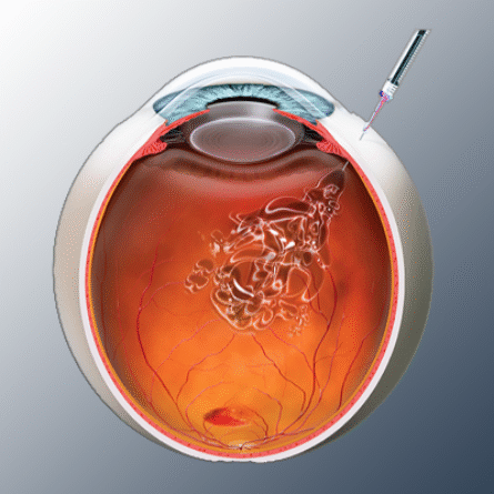 جراحات الشبكية والجسم الزجاجي
