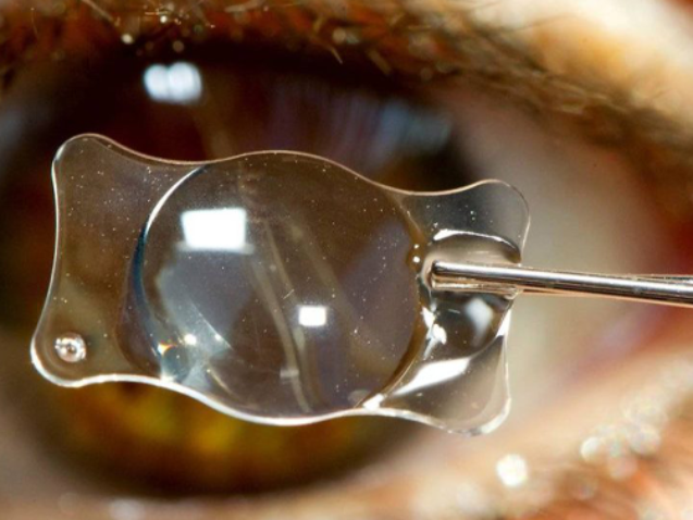 عملية زراعة العدسات لتصحيح عيوب الإبصار