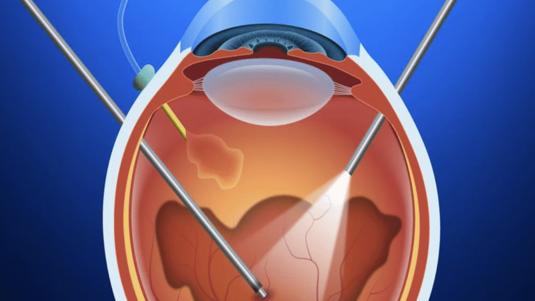 ماهو الجسم الزجاجي للعين: التركيب، الوظائف، الأمراض، التشخيص والعلاج