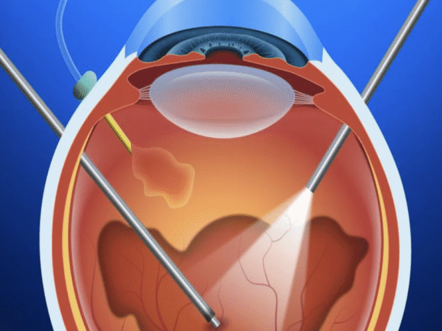 ماهو الجسم الزجاجي للعين: التركيب، الوظائف، الأمراض، التشخيص والعلاج