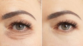 جراحات تجميل العيون وشد والجفون