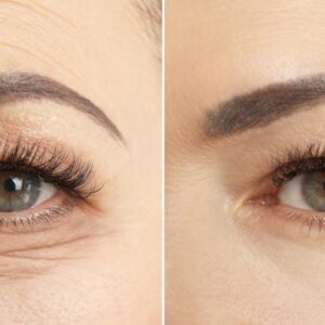 جراحات تجميل العيون وشد والجفون