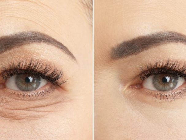 جراحات تجميل العيون وشد والجفون