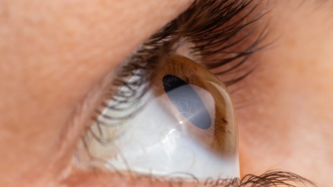 افضل دكتور لعلاج القرنية المخروطية في مصر