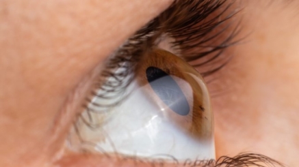 افضل دكتور لعلاج القرنية المخروطية في مصر