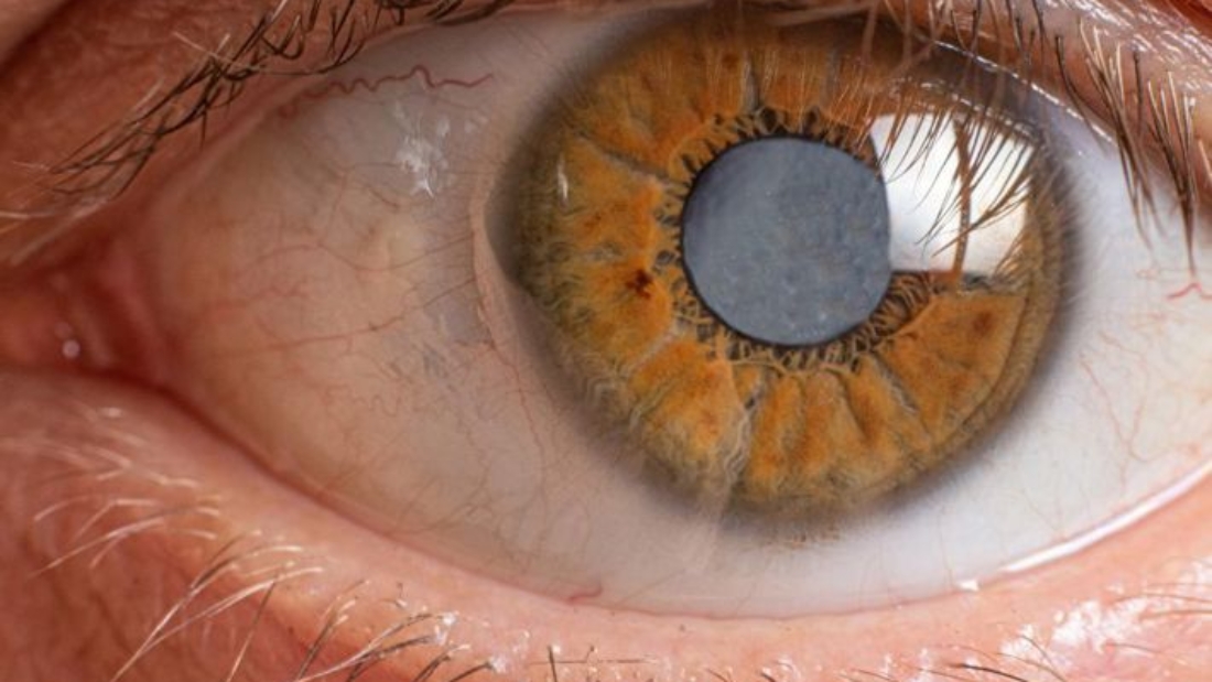 عملية المياه البيضاء بالفاكو