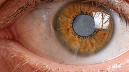 عملية المياه البيضاء بالفاكو