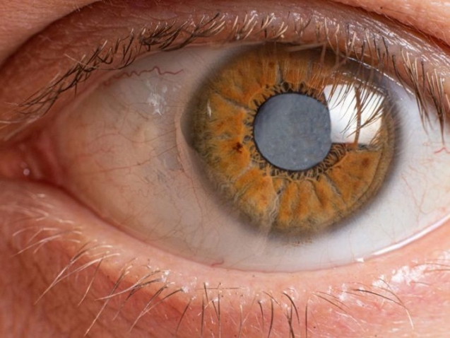 عملية المياه البيضاء بالفاكو