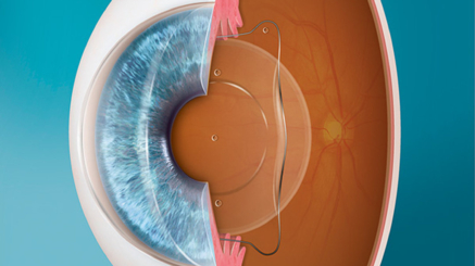 سعر زراعة عدسات ICL في مصر
