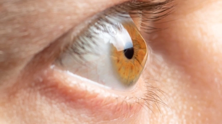 علاج القرنية المخروطية