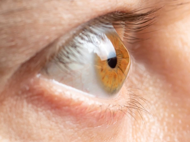 علاج القرنية المخروطية